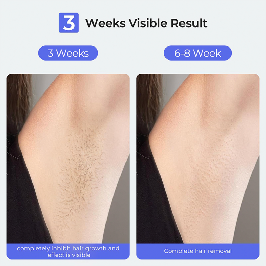 T75S - HAIR REMOVAL