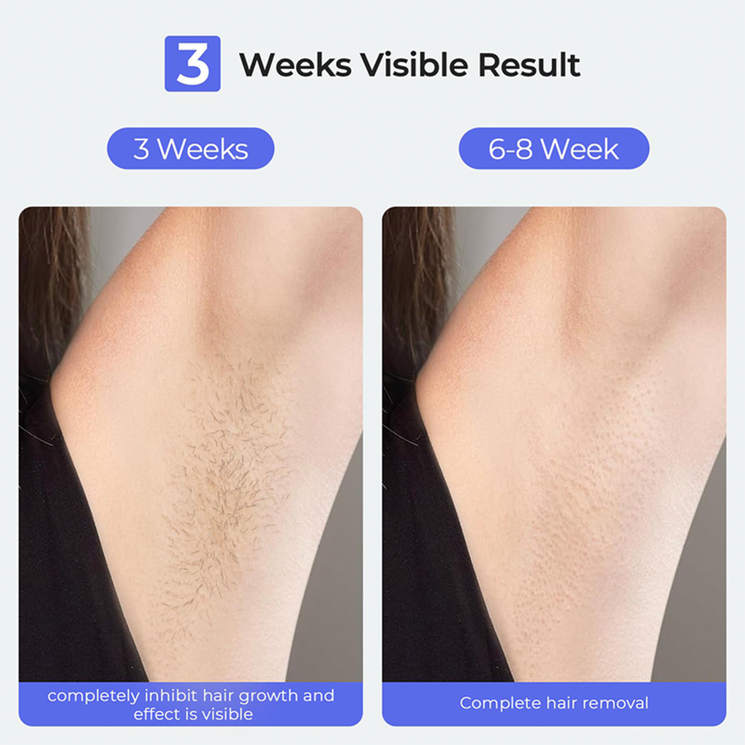T75S - HAIR REMOVAL